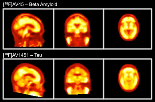 PET brain scans reveal beta amyloid and tau protein structures characteristic of Alzheimer’s disease, but head movements can render the scans unusable.